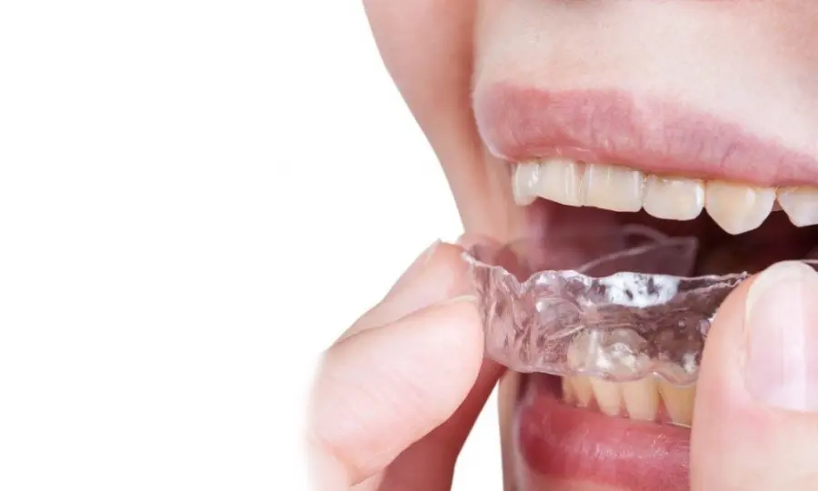 Bruxismo: bite rigido o morbido?