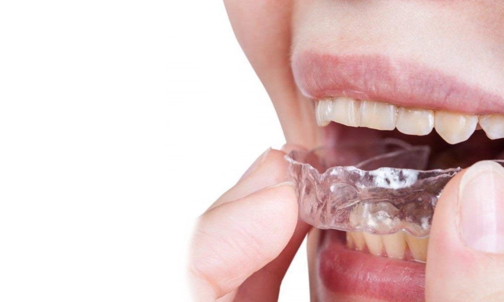 Bruxismo: bite rigido o morbido?