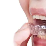 Bruxismo: bite rigido o morbido?